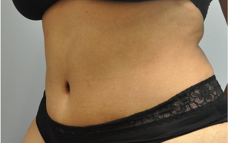 Tummy Tuck Before & After Gallery - Patient 158773 - Image 6