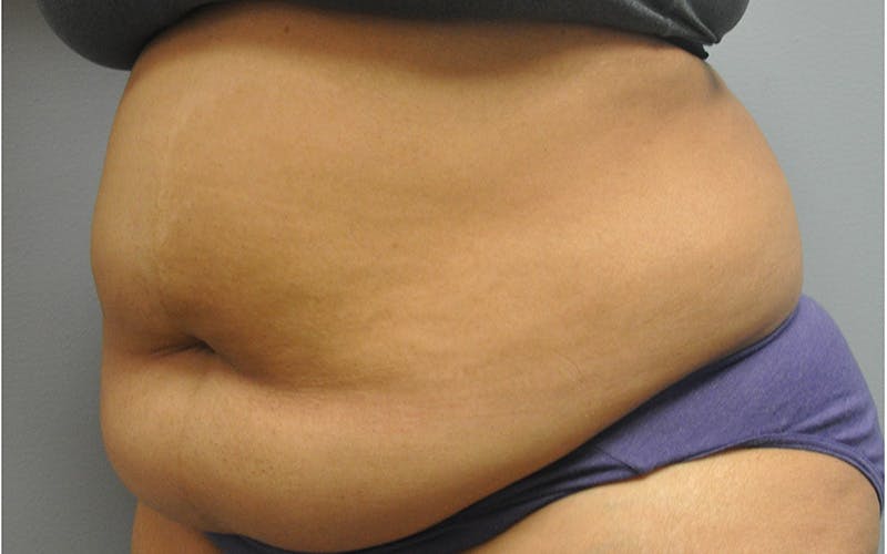 Tummy Tuck Before & After Gallery - Patient 158773 - Image 5