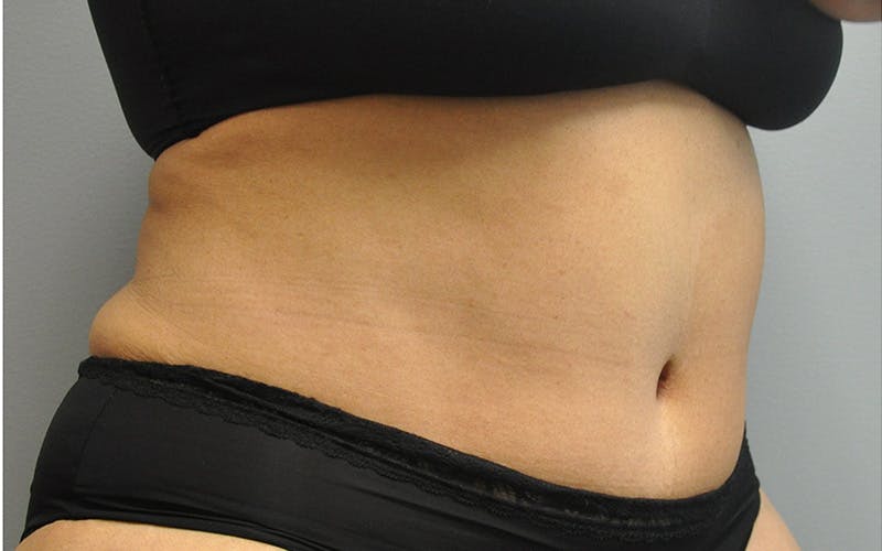 Tummy Tuck Before & After Gallery - Patient 158773 - Image 4