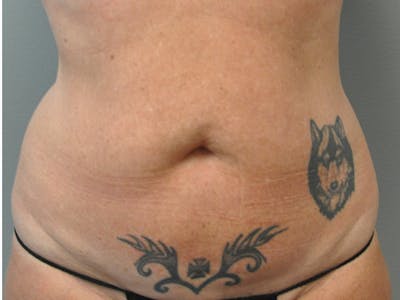 Tummy Tuck Before & After Gallery - Patient 361176 - Image 1