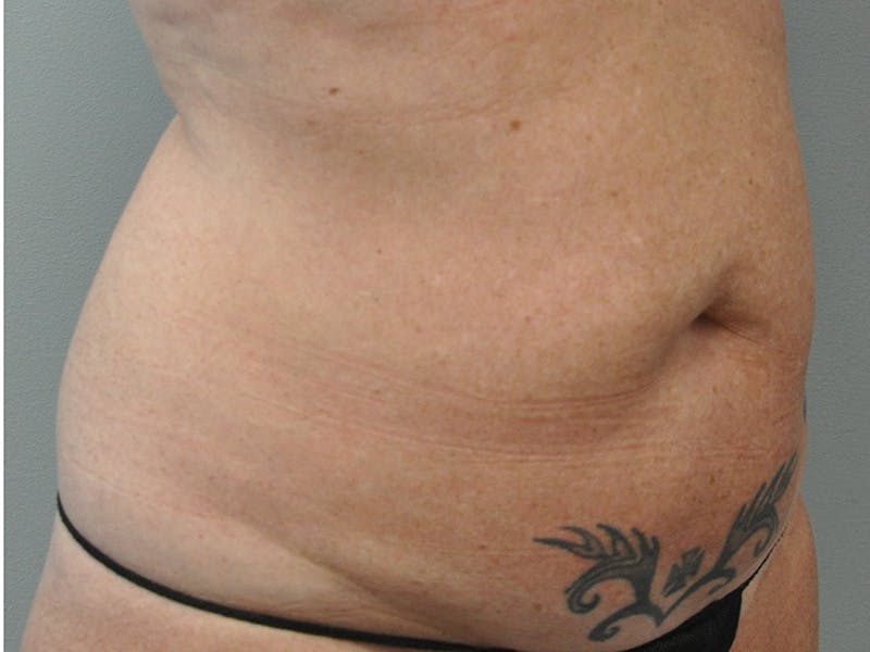 Tummy Tuck Before & After Gallery - Patient 361176 - Image 3