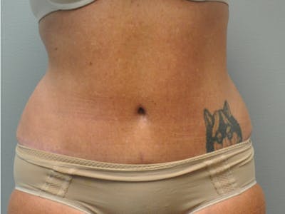 Tummy Tuck Before & After Gallery - Patient 361176 - Image 2