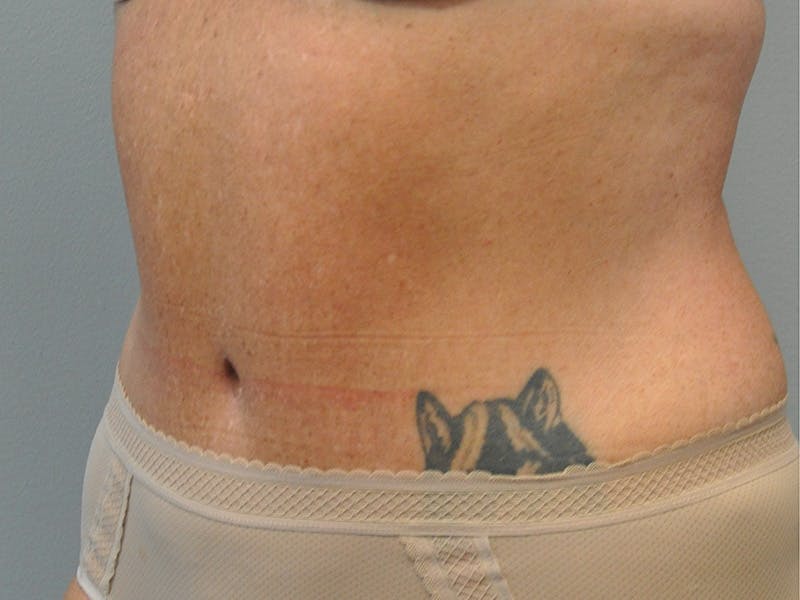 Tummy Tuck Before & After Gallery - Patient 361176 - Image 6
