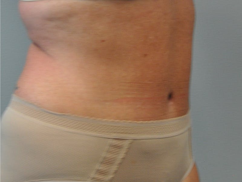 Tummy Tuck Before & After Gallery - Patient 361176 - Image 4