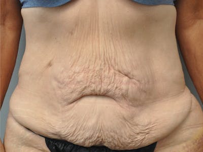 Tummy Tuck Before & After Gallery - Patient 305890 - Image 1