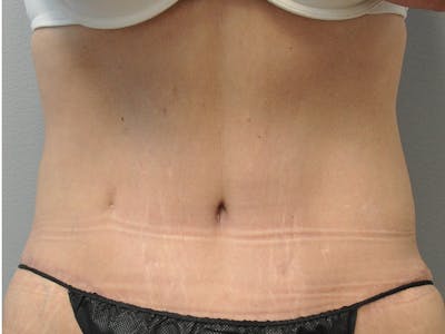 Tummy Tuck Before & After Gallery - Patient 305890 - Image 2