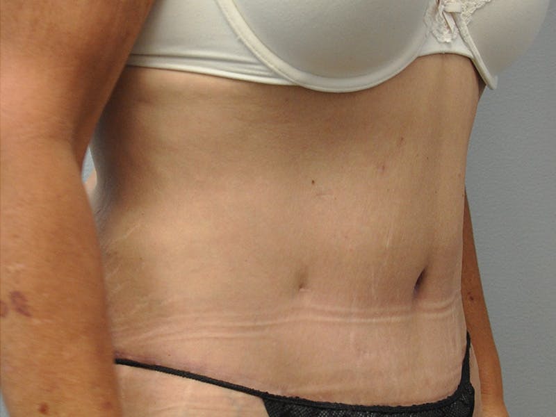 Tummy Tuck Before & After Gallery - Patient 305890 - Image 4