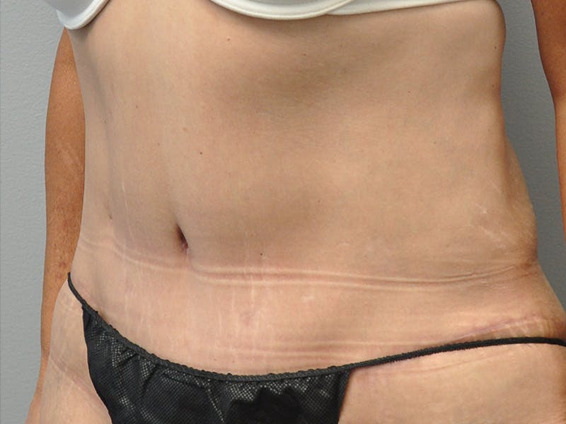 Tummy Tuck Before & After Gallery - Patient 305890 - Image 6