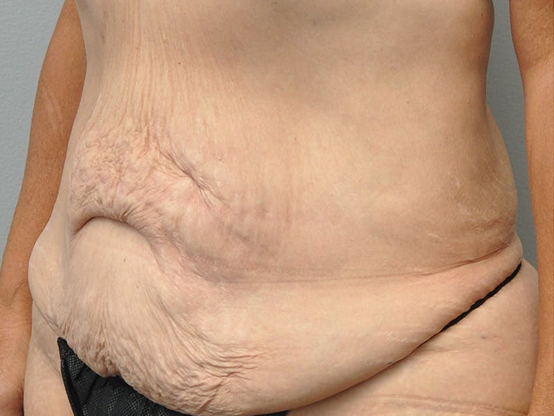 Tummy Tuck Before & After Gallery - Patient 305890 - Image 5
