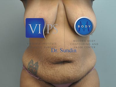 Tummy Tuck Before & After Gallery - Patient 287707 - Image 1