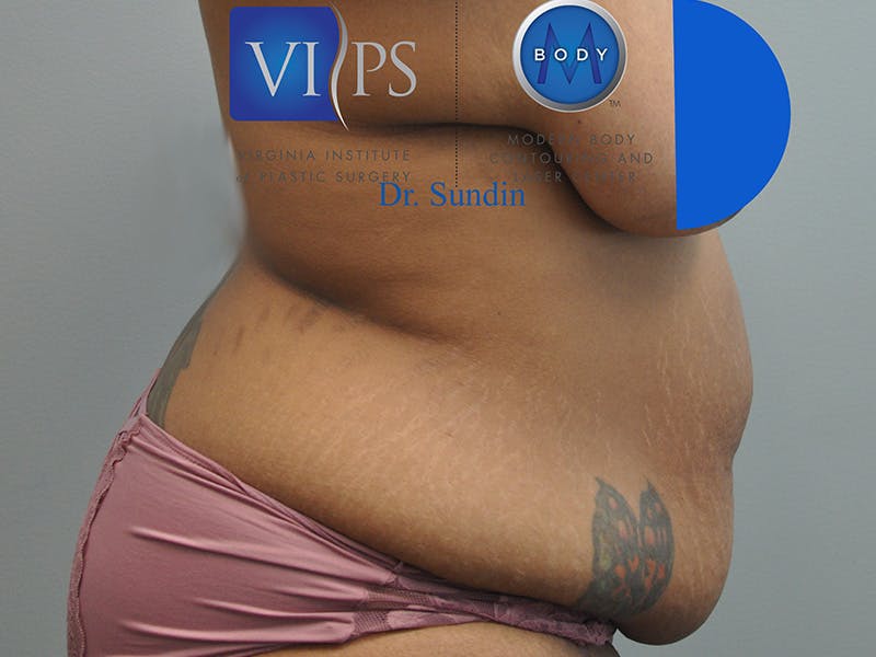 Tummy Tuck Before & After Gallery - Patient 287707 - Image 3
