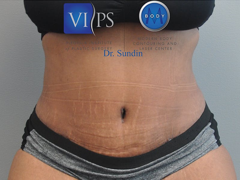 Tummy Tuck Before & After Gallery - Patient 287707 - Image 2