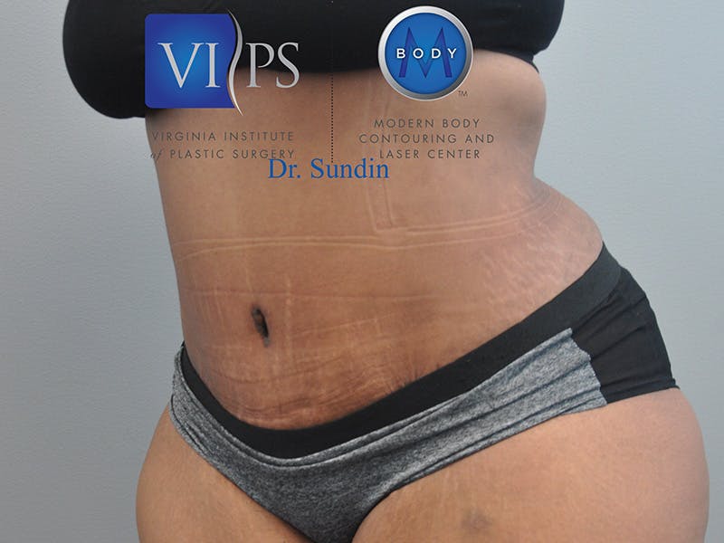 Tummy Tuck Before & After Gallery - Patient 287707 - Image 6