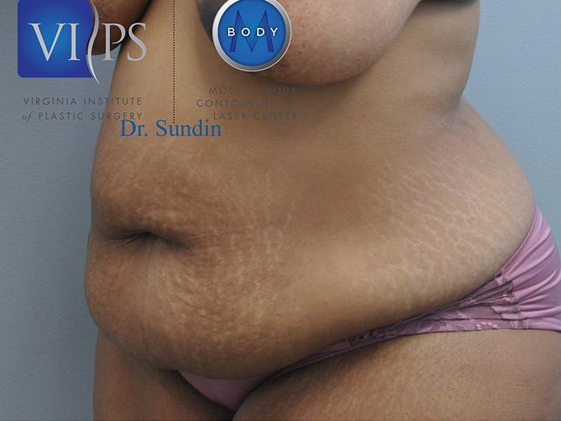 Tummy Tuck Before & After Gallery - Patient 287707 - Image 5