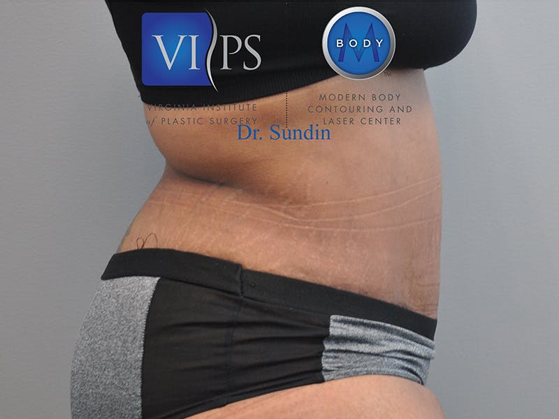 Tummy Tuck Before & After Gallery - Patient 287707 - Image 4
