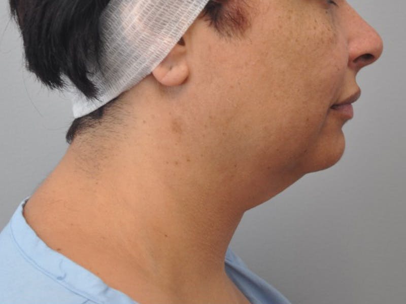 CO2 Laser Before & After Gallery - Patient 232708 - Image 1