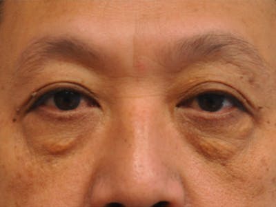 CO2 Laser Before & After Gallery - Patient 208986 - Image 1