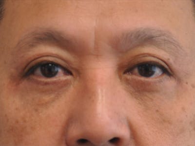 CO2 Laser Before & After Gallery - Patient 208986 - Image 2