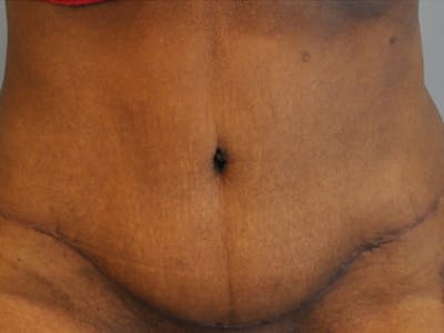 CO2 Laser Before & After Gallery - Patient 398817 - Image 2
