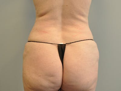 CO2 Laser Before & After Gallery - Patient 856694 - Image 1
