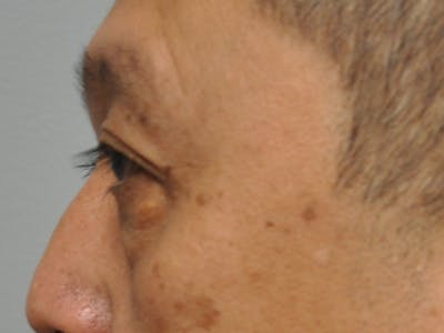 CO2 Laser Before & After Gallery - Patient 176512 - Image 1