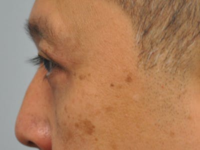 CO2 Laser Before & After Gallery - Patient 176512 - Image 2