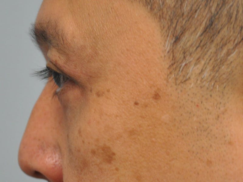 CO2 Laser Before & After Gallery - Patient 176512 - Image 2