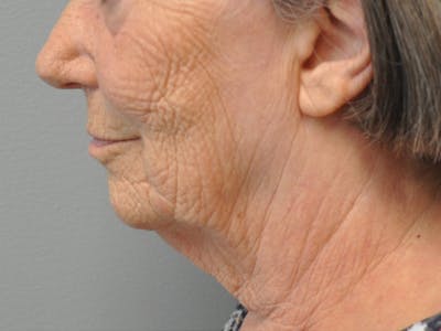 CO2 Laser Before & After Gallery - Patient 241484 - Image 1