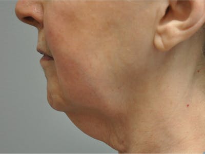 CO2 Laser Before & After Gallery - Patient 395368 - Image 1