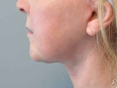 CO2 Laser Before & After Gallery - Patient 395368 - Image 2