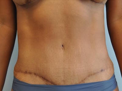 CO2 Laser Before & After Gallery - Patient 107605 - Image 2