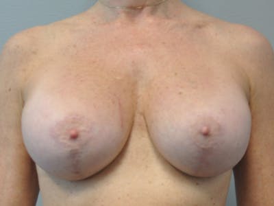 CO2 Laser Before & After Gallery - Patient 214096 - Image 2
