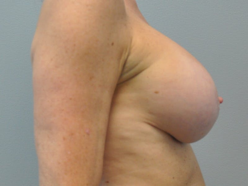CO2 Laser Before & After Gallery - Patient 214096 - Image 6