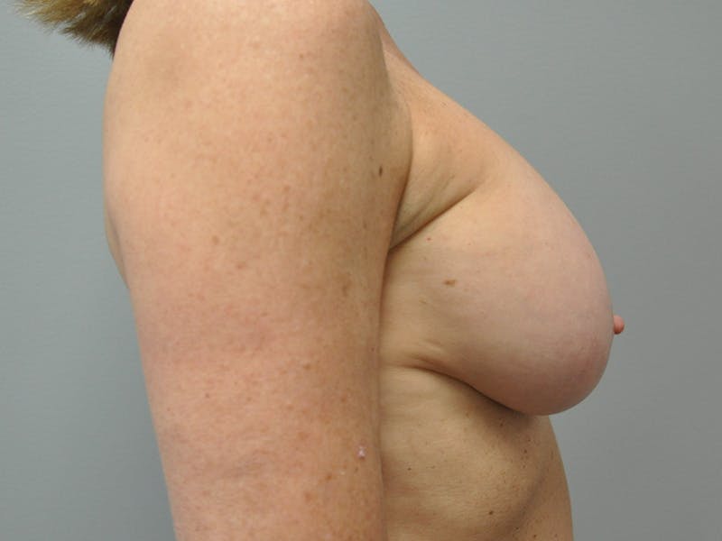 CO2 Laser Before & After Gallery - Patient 214096 - Image 5