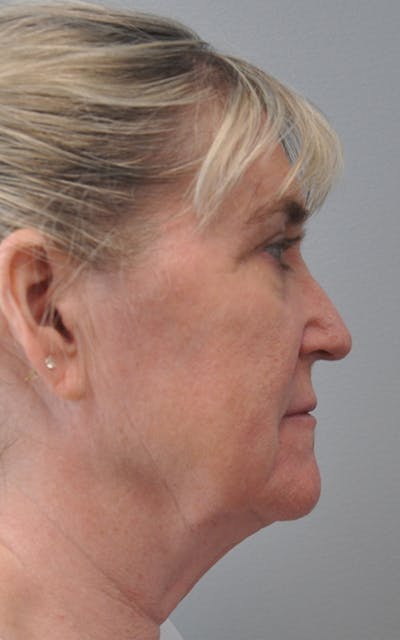 CO2 Laser Before & After Gallery - Patient 390194 - Image 1