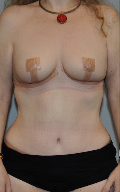 CO2 Laser Before & After Gallery - Patient 227566 - Image 2