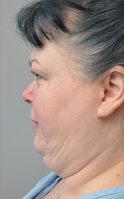 CO2 Laser Before & After Gallery - Patient 281058 - Image 1