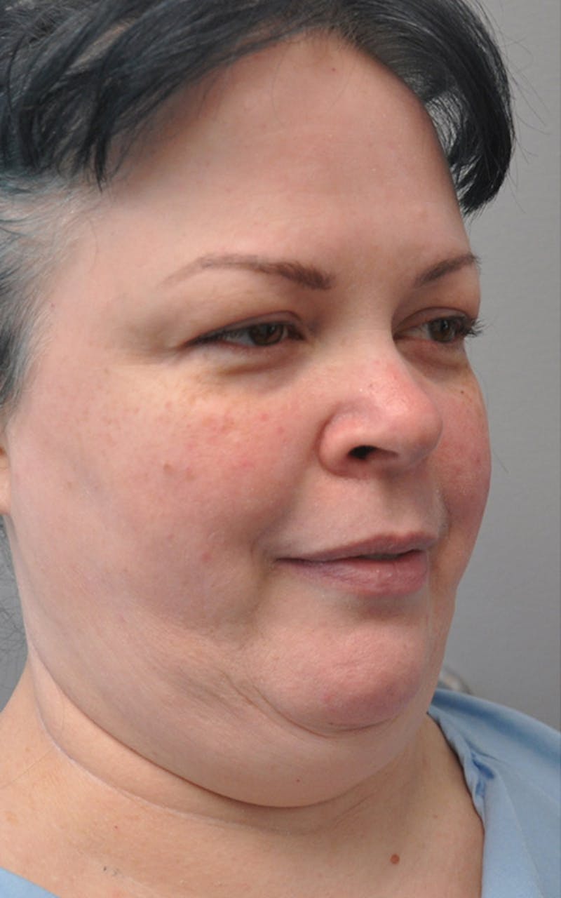 CO2 Laser Before & After Gallery - Patient 281058 - Image 3