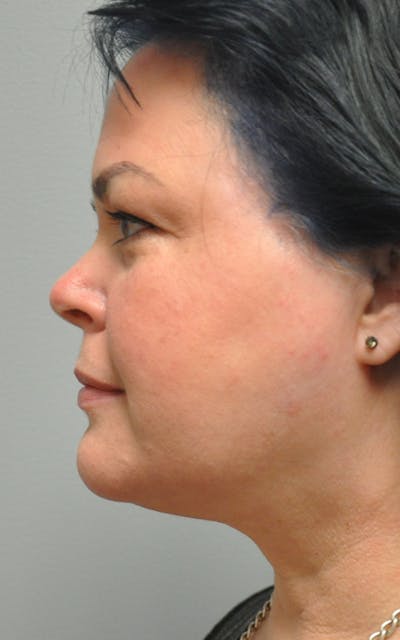CO2 Laser Before & After Gallery - Patient 281058 - Image 2