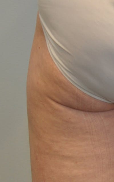 CO2 Laser Before & After Gallery - Patient 299788 - Image 2
