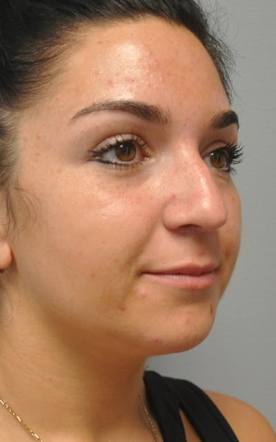 CO2 Laser Before & After Gallery - Patient 323801 - Image 1