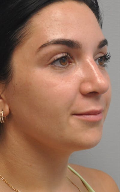 CO2 Laser Before & After Gallery - Patient 323801 - Image 2