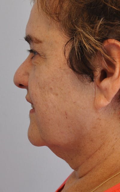 CO2 Laser Before & After Gallery - Patient 357772 - Image 1