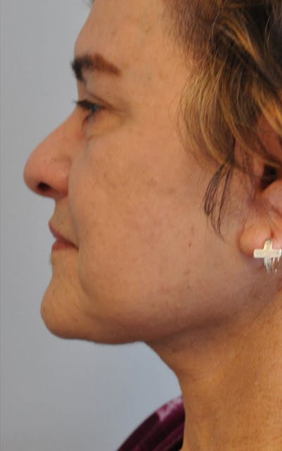 CO2 Laser Before & After Gallery - Patient 357772 - Image 2