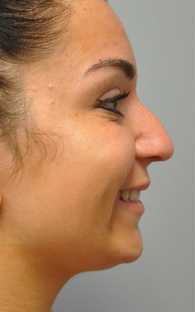 CO2 Laser Before & After Gallery - Patient 155501 - Image 1
