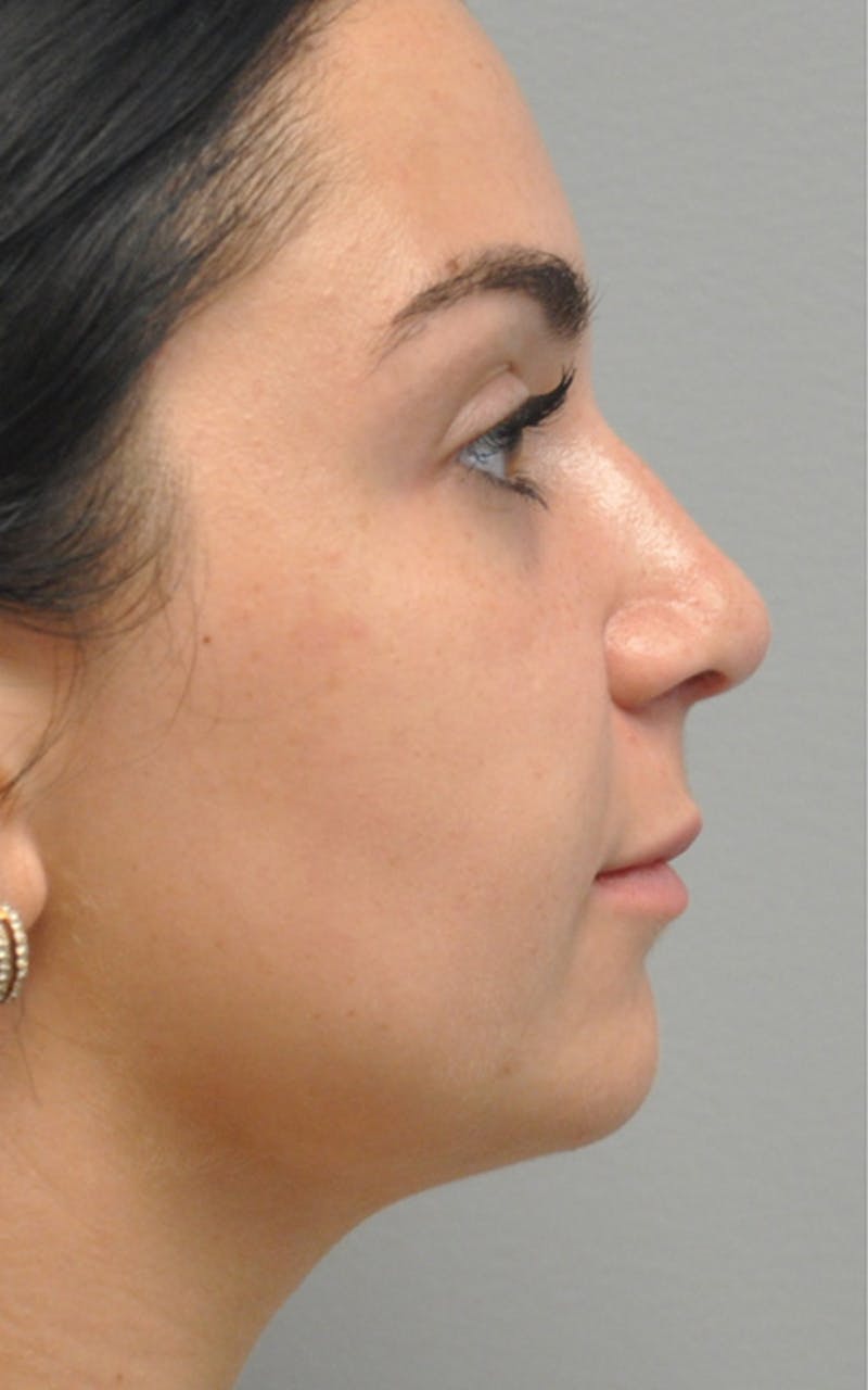 CO2 Laser Before & After Gallery - Patient 155501 - Image 2