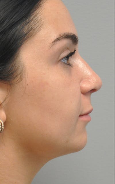 CO2 Laser Before & After Gallery - Patient 155501 - Image 2