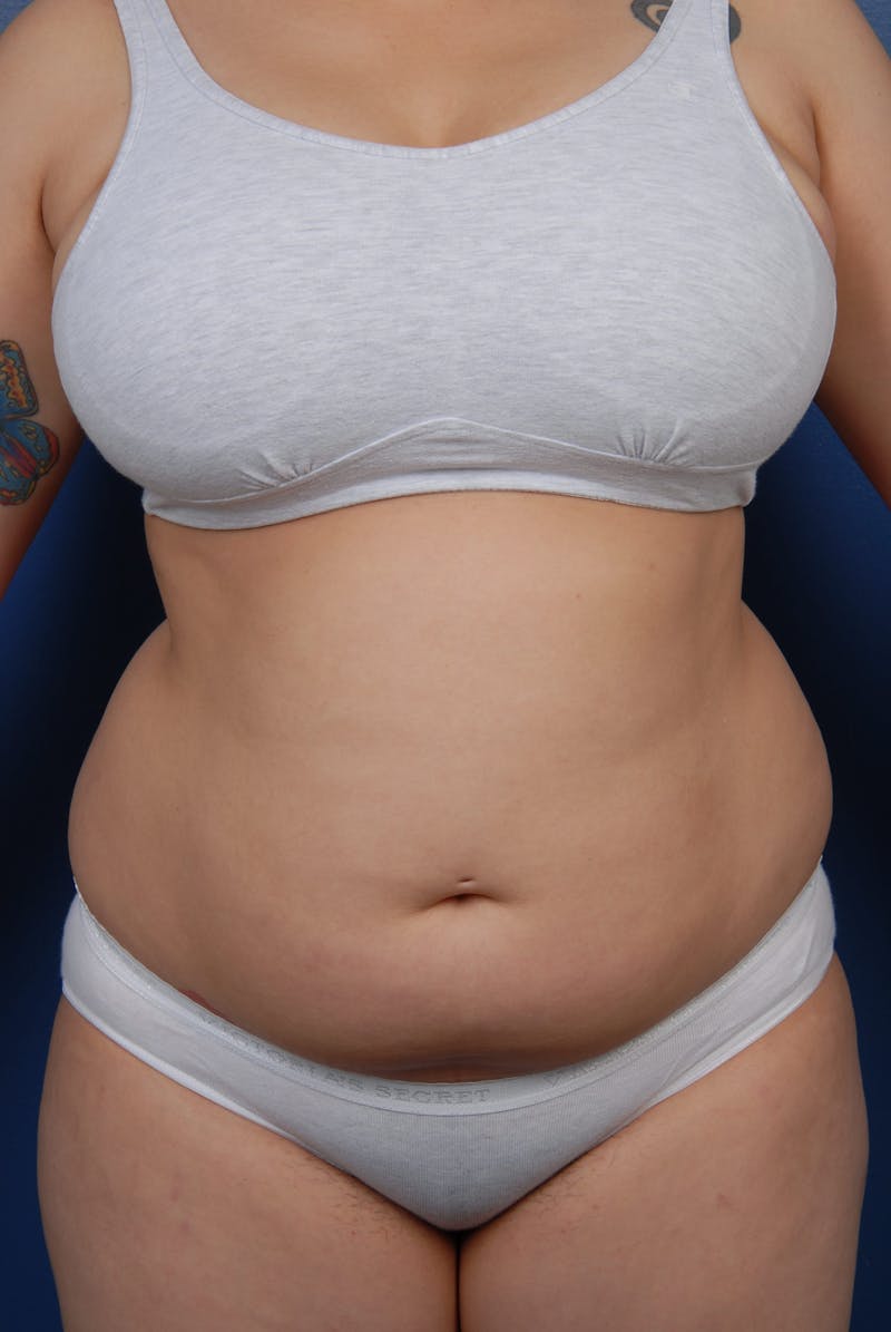 Liposuction Before & After Gallery - Patient 67102340 - Image 1