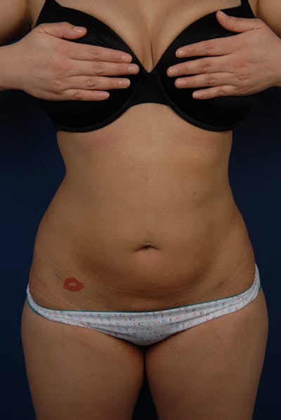 Liposuction Before & After Gallery - Patient 67102340 - Image 2