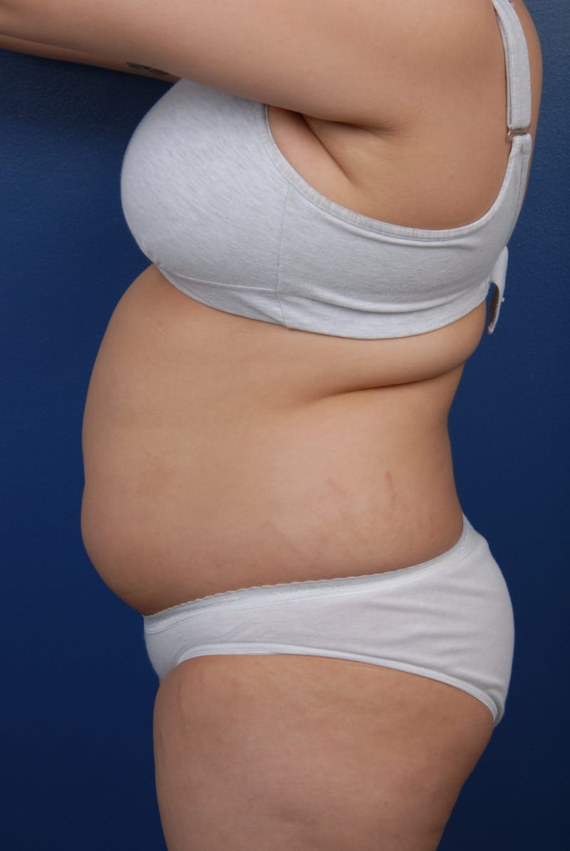 Liposuction Before & After Gallery - Patient 67102340 - Image 5